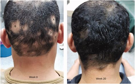 Efficacy Of Intradermal Minoxidil 5 Injections For Treatment Of Patchy