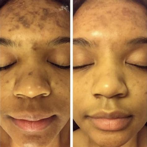 Albums 90 Images Hydroquinone Before And After Pictures Superb