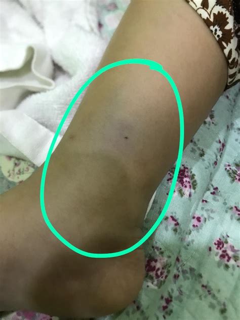 Kaki bengkak bila terjadi dalam waktu temporer, mungkin disebabkan oleh posisi berdiri yang tidak terlalu lama atau baru saja melakukan perjalanan panjang. "Kakinya Bengkak Sampai Lutut," Anak Mengadu Sakit Kaki ...