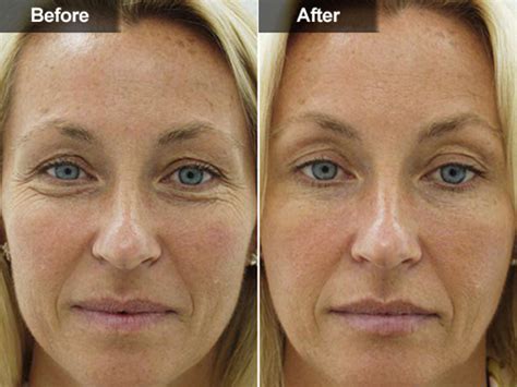 Individual factors that influence the frequency of retreatment for botox around the eyes include: Botox in Mclean VA & Woodbridge, VA | Skin & Laser Surgery ...