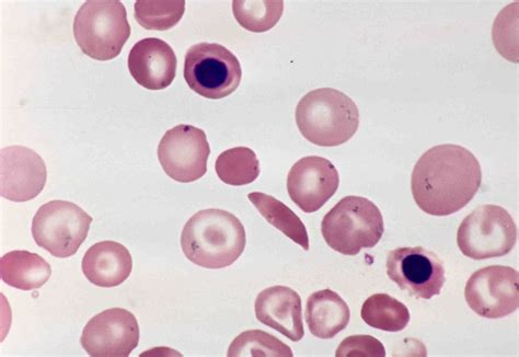 Hemoglobin ss disease, sickle cell anemia. Why do you see Howell-Jolly bodies in sickle cell anemia ...