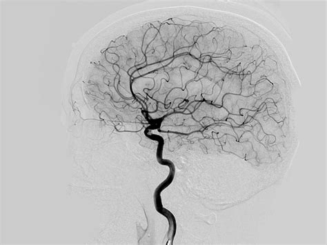 Cerebral Angiogramdsa