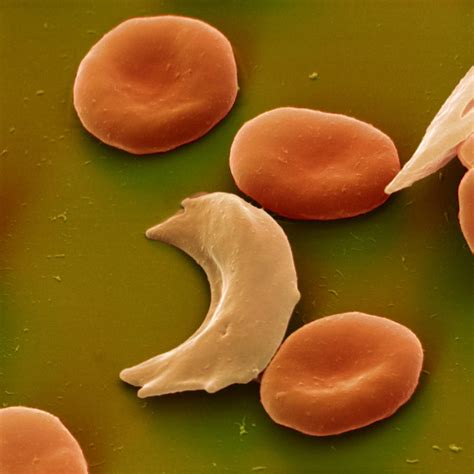 Sickle Cell Anemia Photograph By Eye Of Science Pixels