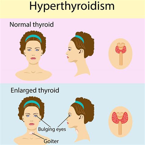 Thyroid Disease Symptoms And Signs