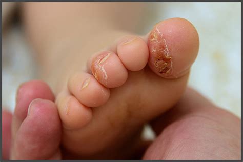 Infant Psoriasis Pictures Psoriasis Expert