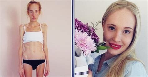 Sejarah perkembangan kesehatan setelah perang dunia ii, perhatian masyarakat mengenai. Definisi Anoreksia Nervosa | Apa Itu Anoreksia Nervosa ...