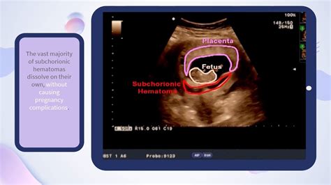 Subchorionic Hematoma Υποχοριονικό αιμάτωμα Ultrasound Cases Youtube