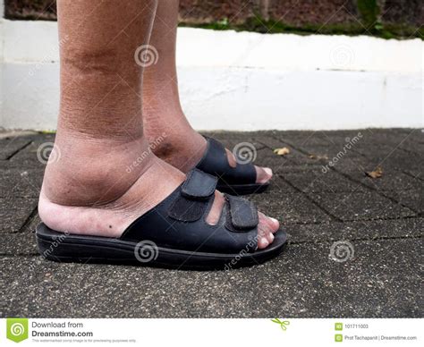 Diabetics often complain of swelling in the feet and legs. The Feet Of Man With Diabetes, Dull And Swollen. Due To ...