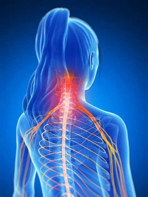 Cervical Radiculopathy Cause Symptoms Treatment Exercise