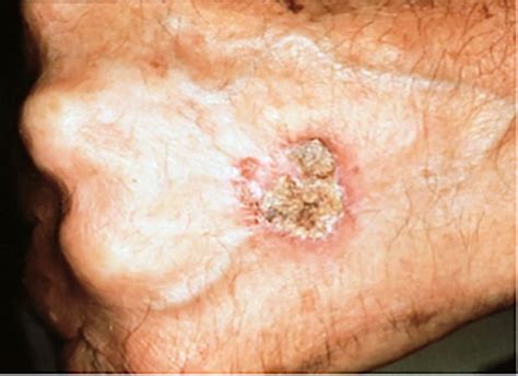 Tratamento Avançado De Carcinoma De Células Escamosas The Skin Cancer
