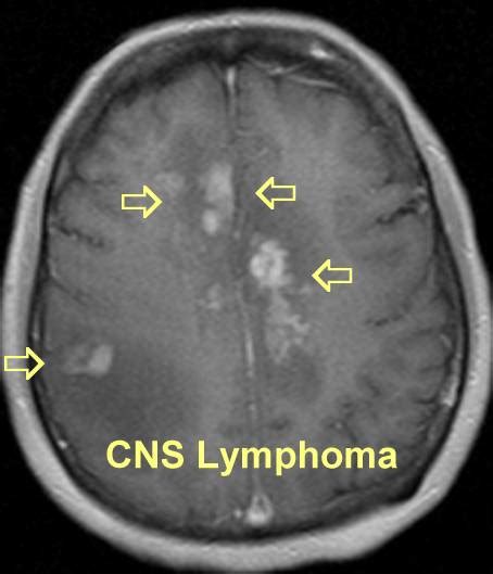 Neurospeak And Clinicspeak Natalizumab And Lymphomas Prof Gs Ms