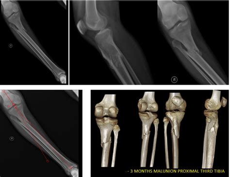 Malunited Proximal Third Tibia Fracture Treated With Open Reduction And