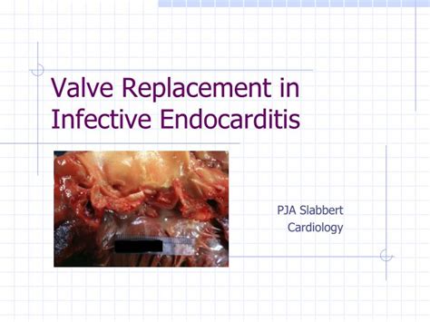 Ppt Valve Replacement In Infective Endocarditis Powerpoint