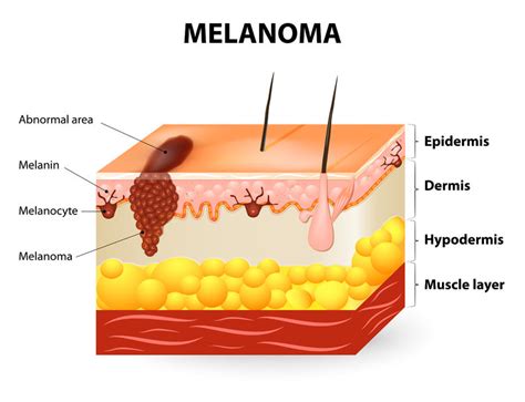 How To Spot The Early Signs Of Melanoma Skin Cancer Babyface