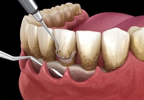 Periodontal Surgery Precision Dental Group