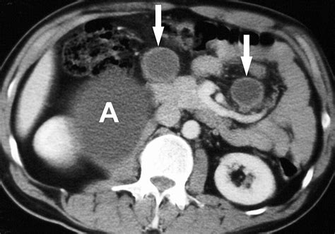 Ct Appearances Of Abdominal Tuberculosis Clinical Radiology