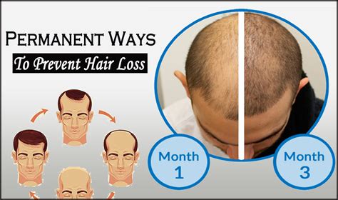 Permanent Ways To Prevent Hair Loss With Hair Treatment