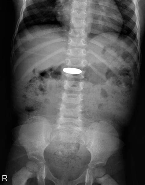 Swallowed Coin X Ray Photograph By Du Cane Medical Imaging Ltd