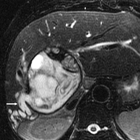 Intrabiliary Rupture Of Hepatic Hydatid Cysts Diagnostic Accuracy Of