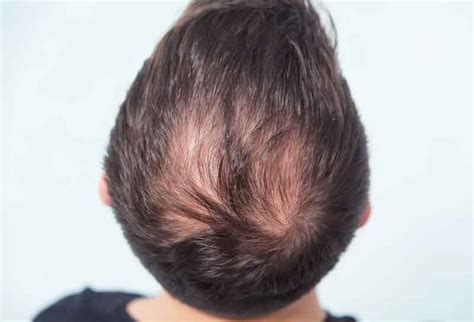 ¿alopecia En La Coronilla Solución Y Tratamientos