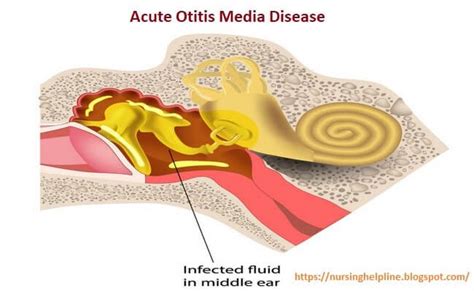 Acute Otitis Media Disease Otitis Media Otitis Nurse Manager