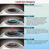 Lasik Eye Surgery Advantages
