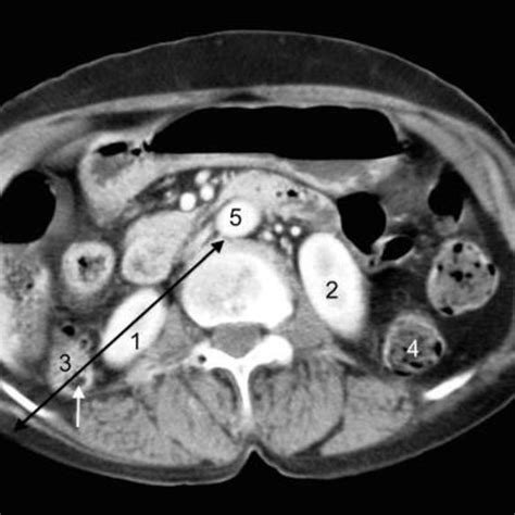 Abdominal Ct Scan At The Level Of The Lower Pole Of Kidneys In A Male