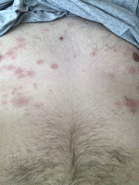 Dry Itchy Rash Mainly On Torso And Back Any Ideas Medical