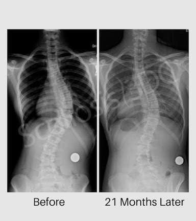 Nama kelainan tulang berdasarkan gambar di atas adalah sebagai berikut. 45 Degree Scoliosis | Scoliosis Before and After ...