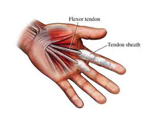Maybe you would like to learn more about one of these? Tendon Injuries or Repair | South Florida Hand Surgery