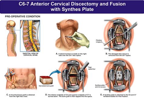 C Anterior Cervical Discectomy And Fusion With Synthes Plate Nbg Drafting And Design