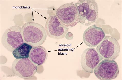 Acute Myelomonocytic Leukemia With Monoblasts And Myeloblasts Eccles