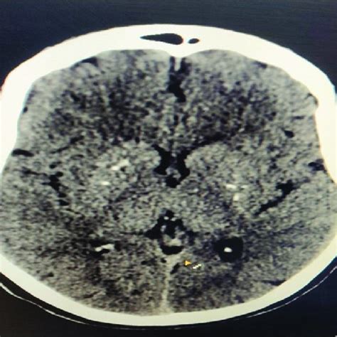 Ct Head Showing Bilateral Basal Ganglia Calcification Download