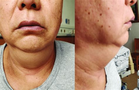 Neck Edema During The First Cycle Of Treatment With Camrelizumab And Download Scientific