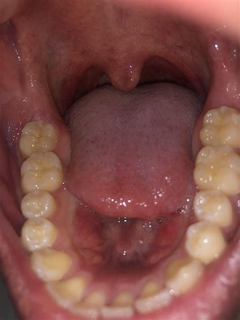 swollen gum behind second molar no wisdom tooth x rayed is this pericoronitis been a few