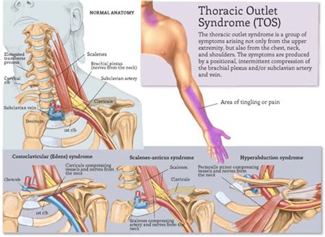 Thoracic Outlet Syndrome Physio Professionals