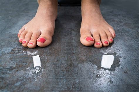 Sweaty Feet Causes Treatments And Information Podiatrist In Visalia