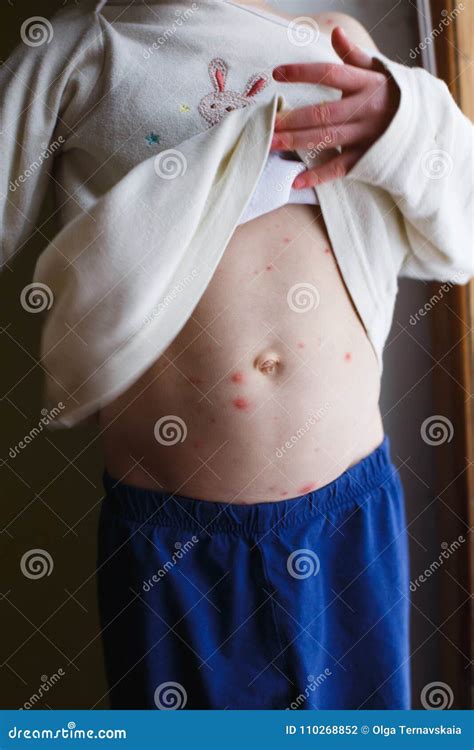 Baby With Chicken Pox Rash Varicella Virus Or Chickenpox Bubble Rash