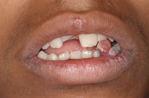 Labial Pyogenic Granuloma Related To Trauma A Case Report And Mini