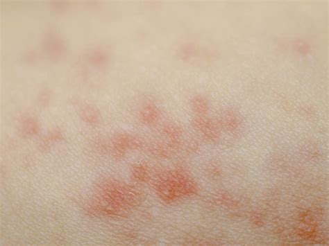 Rashes Eczema And Skin Conditions In Children Babycenter