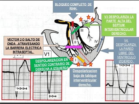 Bloqueos De Rama Del Haz De His