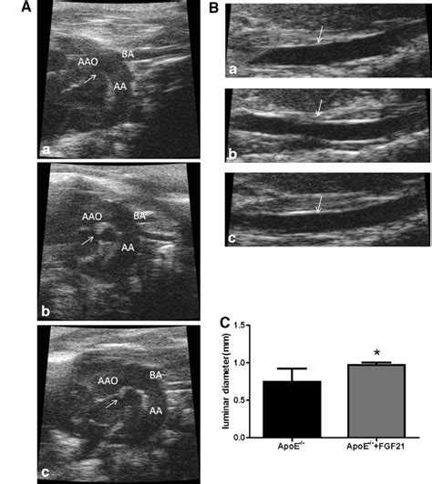 Morphological Study Of Atherosclerotic Aortas By Ultrasonography A