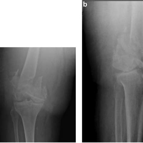 Anteroposterior A And Lateral B Injury Radiographs Demonstrating