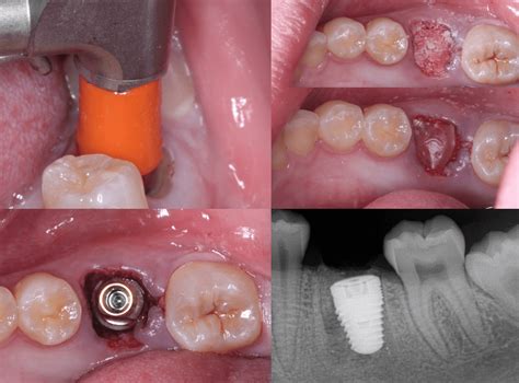 Punk Your Endodontist Immediate Molar Implant Through A Tooth 7mm