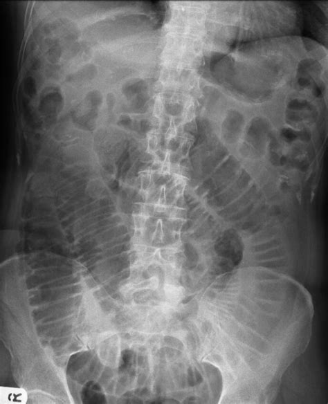 Abdominal X Ray Interpretation Geeky Medics