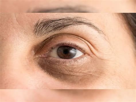 Dark Circles Removal Tips Know Dark Circle Ke Gharelu Upay Samp