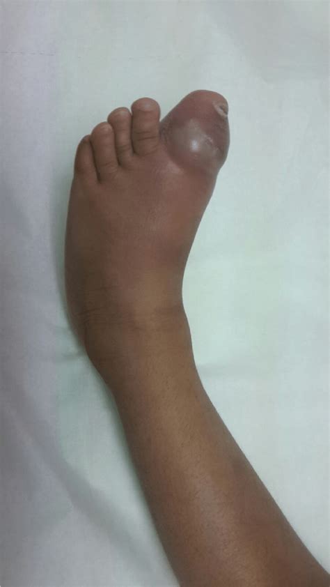 Showing Collection Of Pus And Swelling And Redness Around