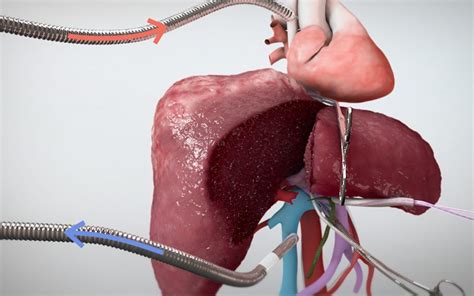 Right Hepatectomy With Cava Resection And Oophorectomy Tvasurg The