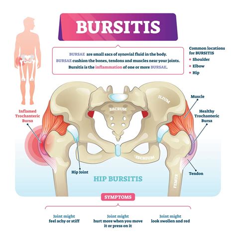 Hip Bursitis Exercises Bursitis Hip Trochanteric Bursitis Sexiezpix Web Porn