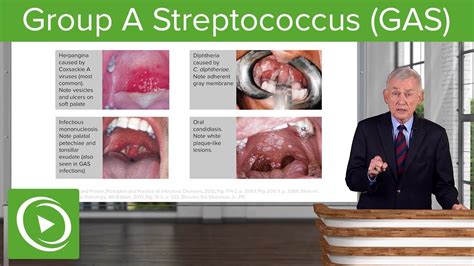 Group A Streptococcus Gas Infectious Diseases Lecturio